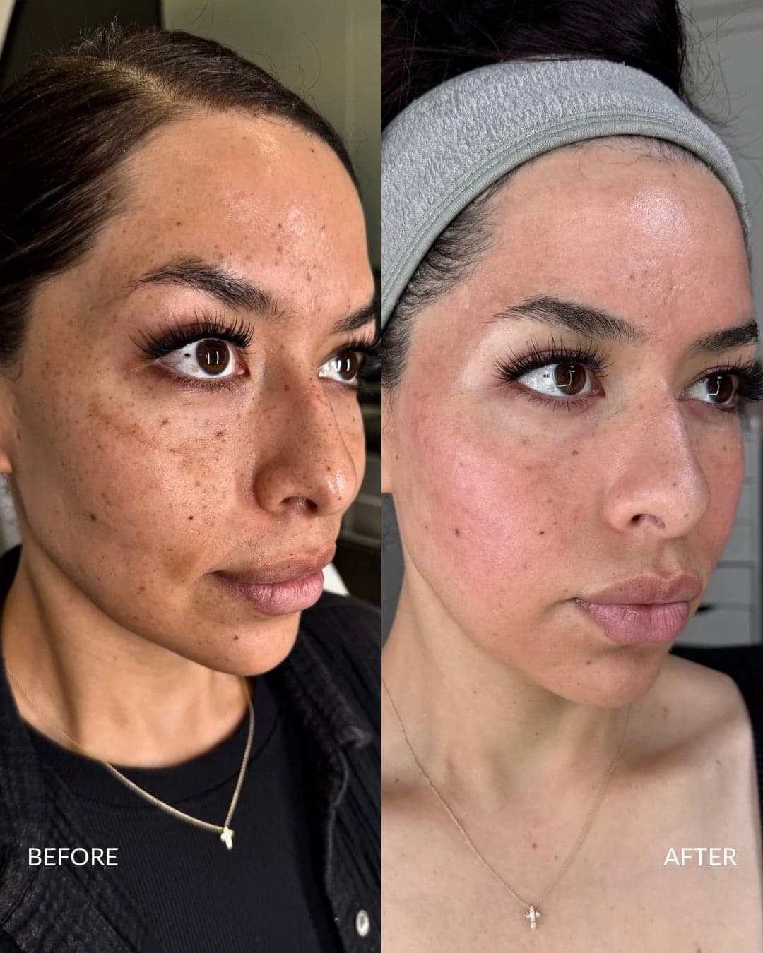 Acne Scar Reconstruction — before and after