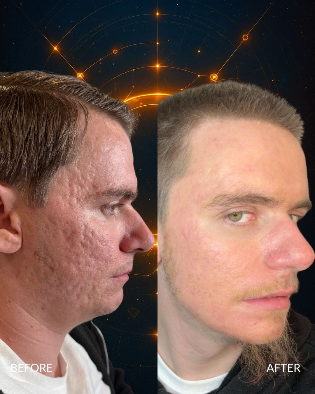 Acne Scar Treatment Before and After