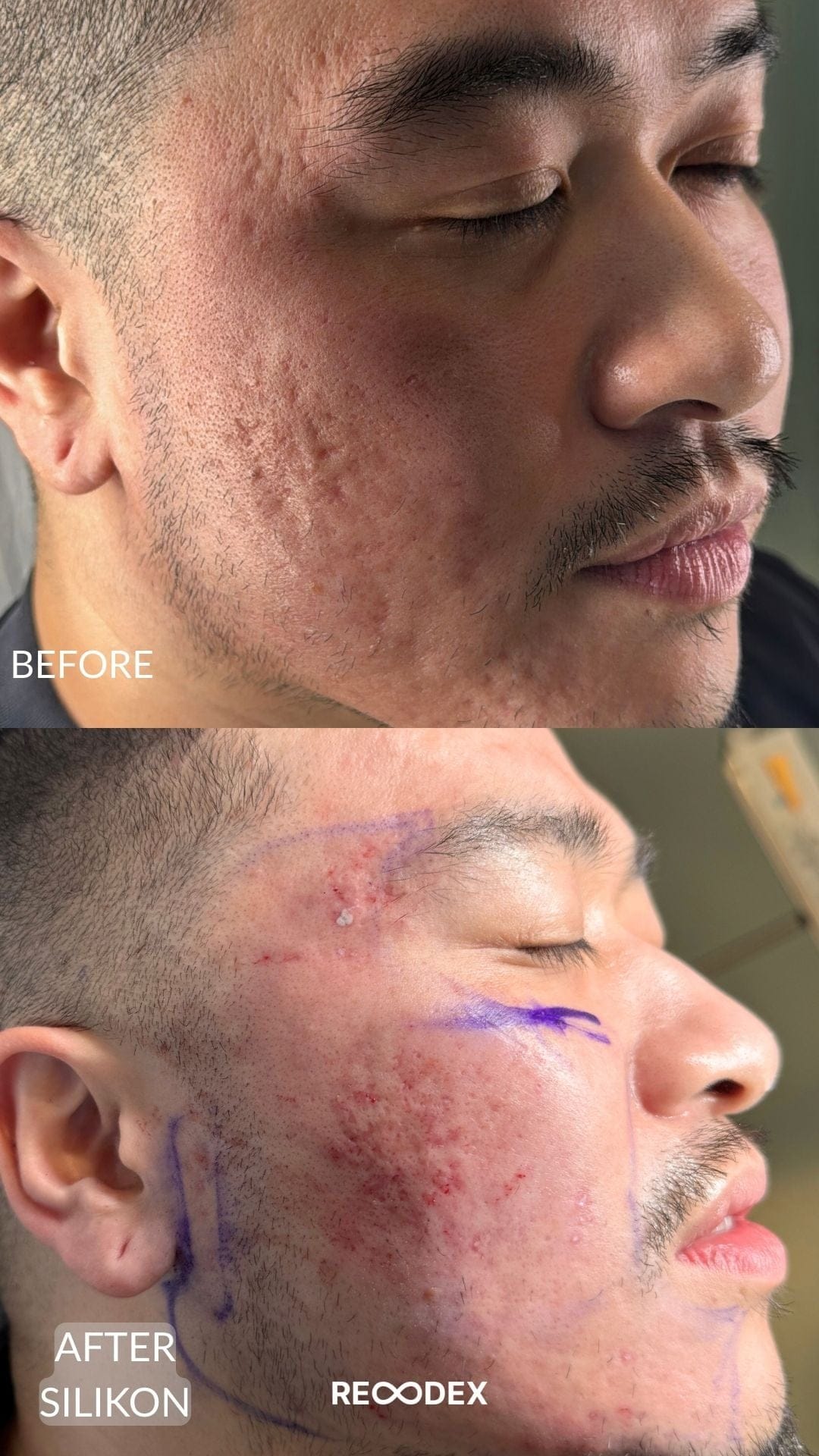 Acne Scar Treatment Before and After