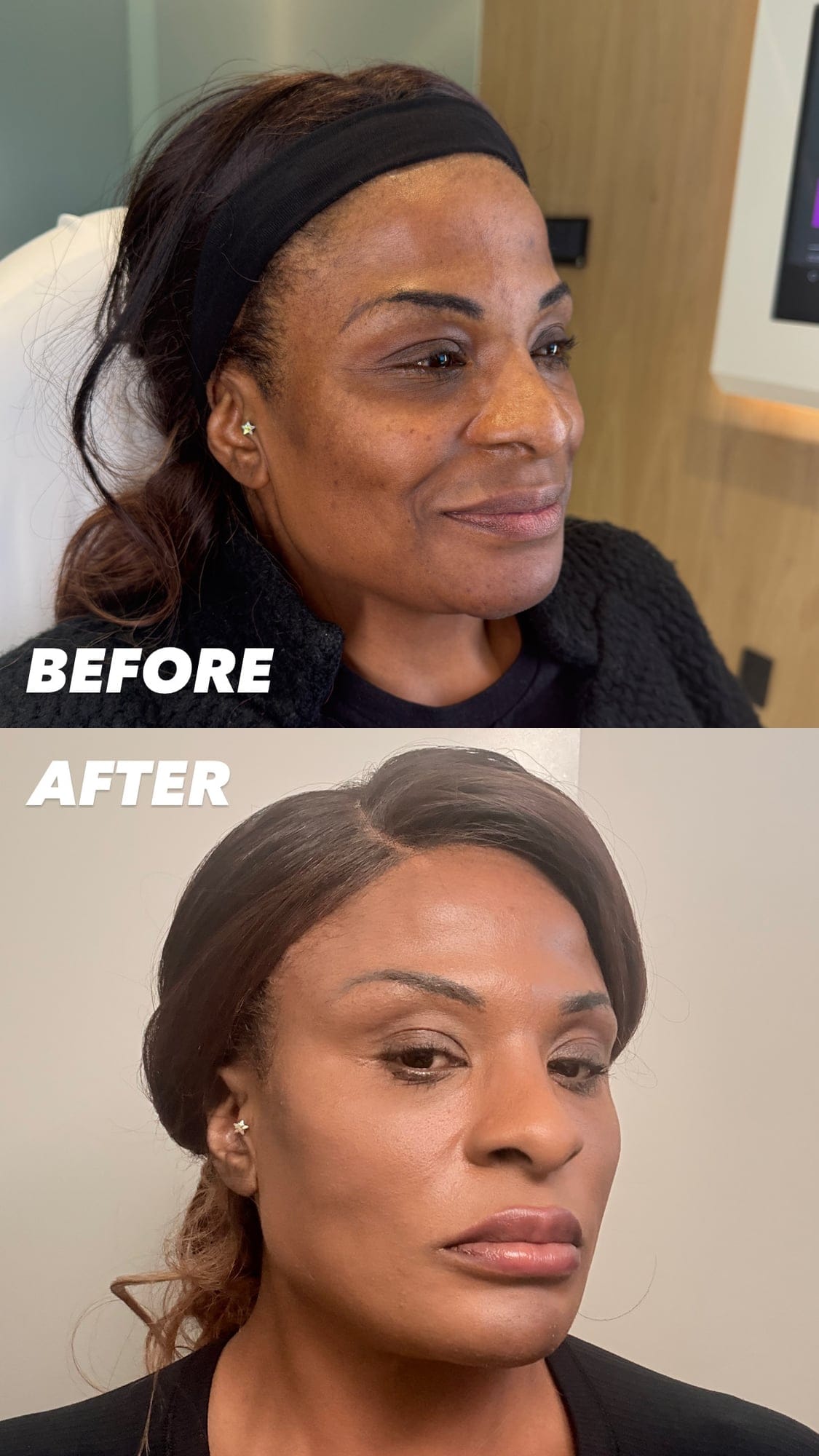 Female Facial Sculpting Before and After