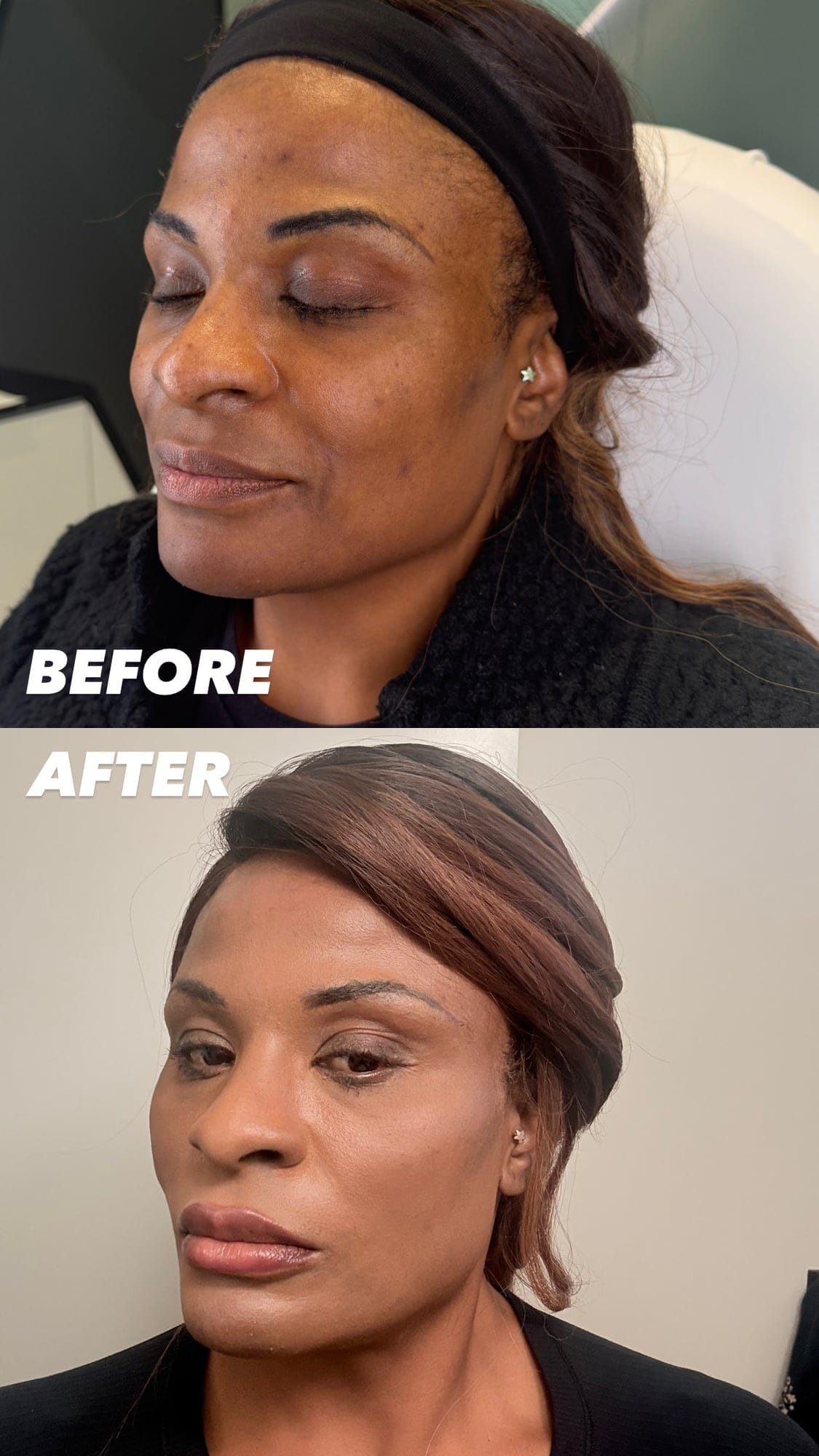 Female Facial Sculpting Before and After