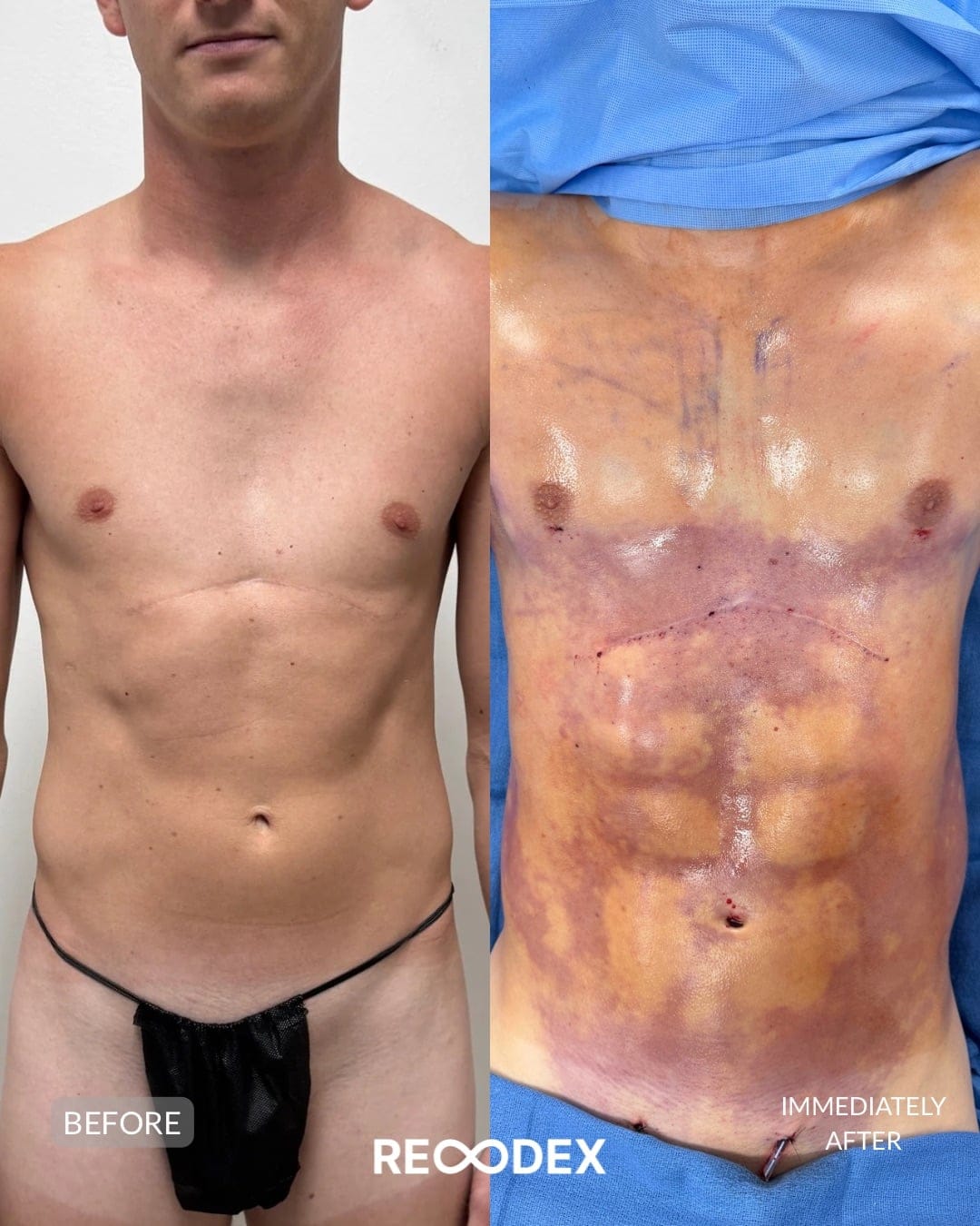 HD Body Sculpting & Implants Before and After
