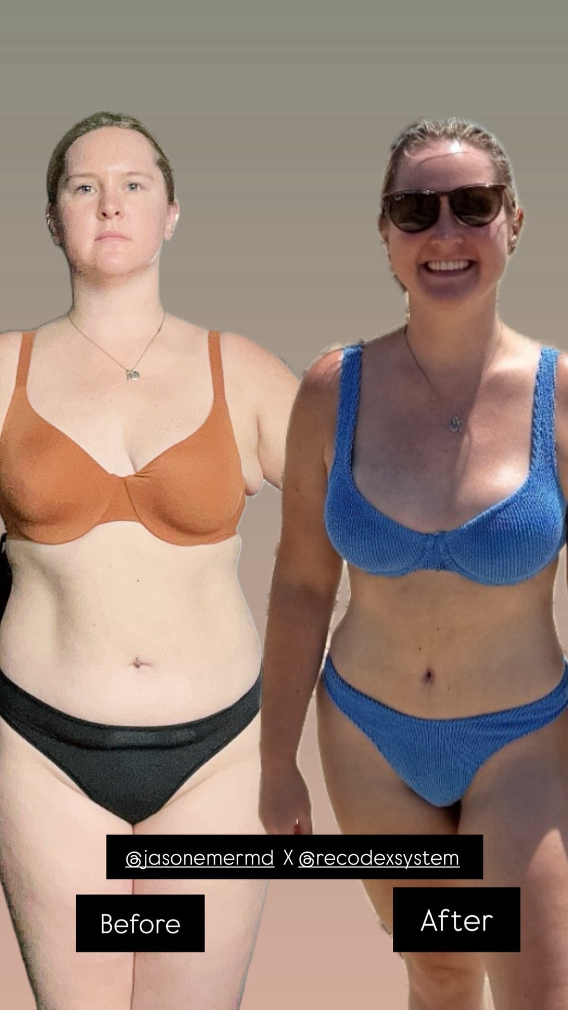 Supermodel Lipo Transformation Before and After